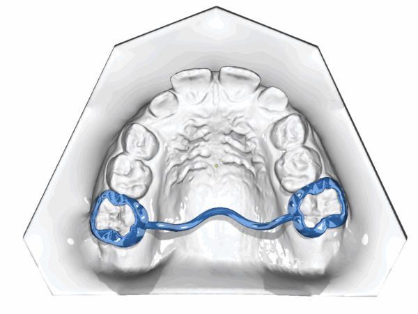 Trans-palatal-/Lingual Arch
