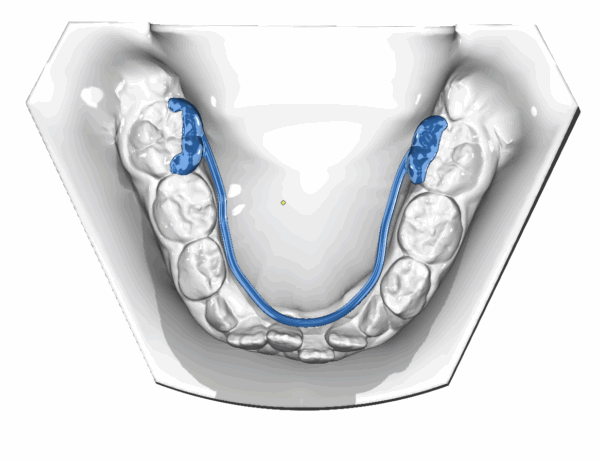 Trans-palatal-/Lingual Arch - Image 2