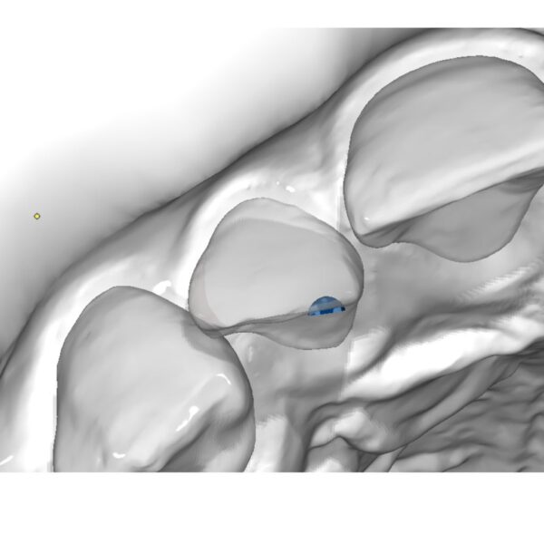 Pressure Point Attachment