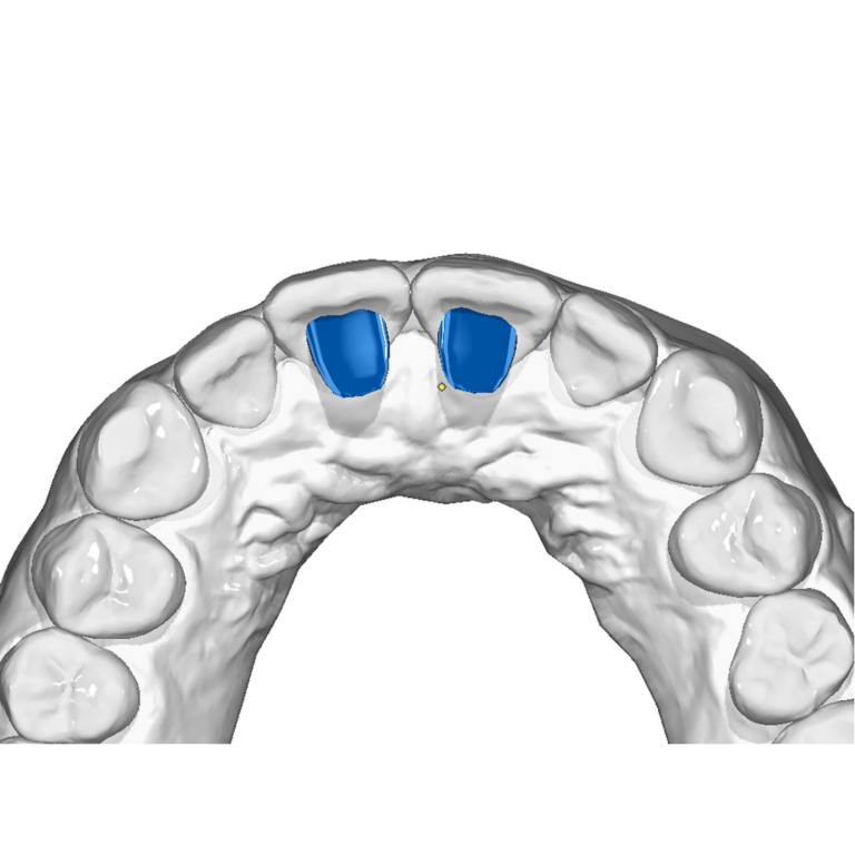 Bite Ramp Retainers Bite Ramp – Ortho-Guru.com